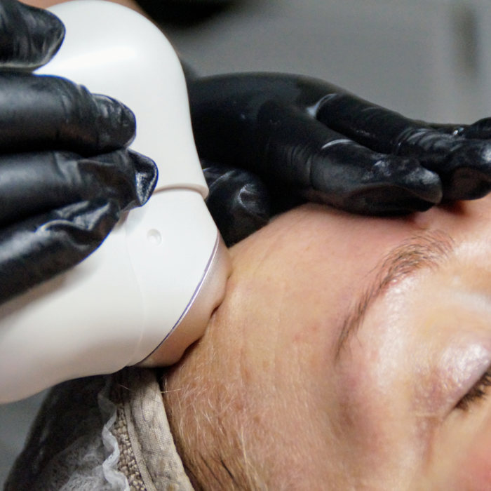 Cold plasma -hoito Kauneushoitola Ilona Kauneus Kuusankoski